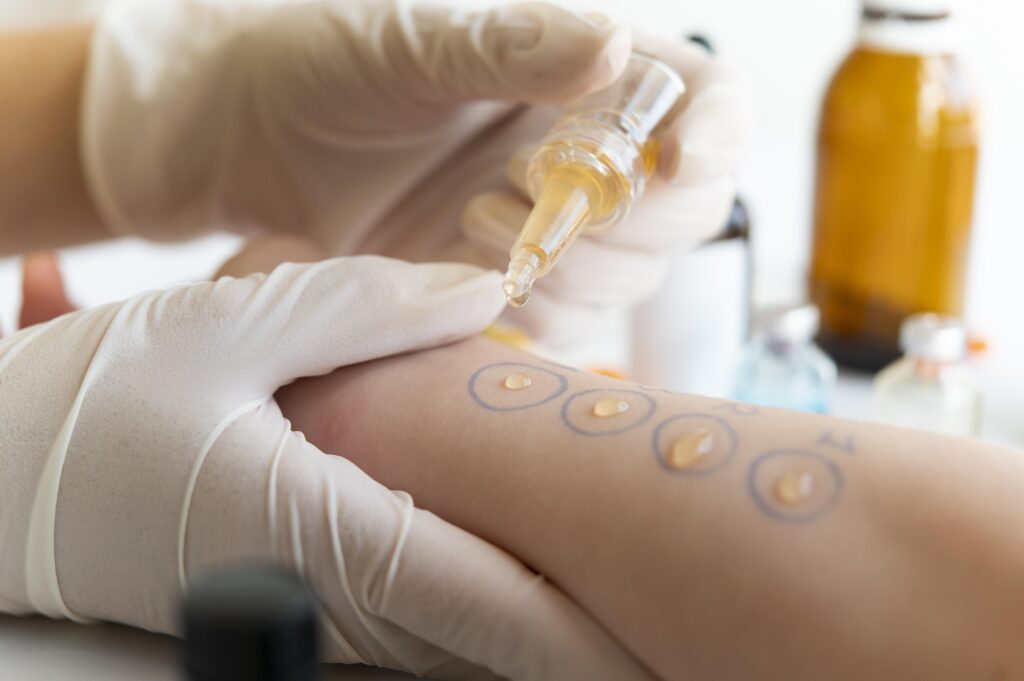 “Skin allergy test being performed on a patient’s arm with allergen drops applied and marked for reaction assessment by a healthcare professional.”